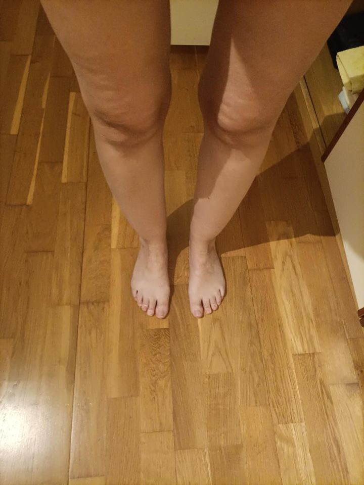 Stage 1 Lipedema Characteristics