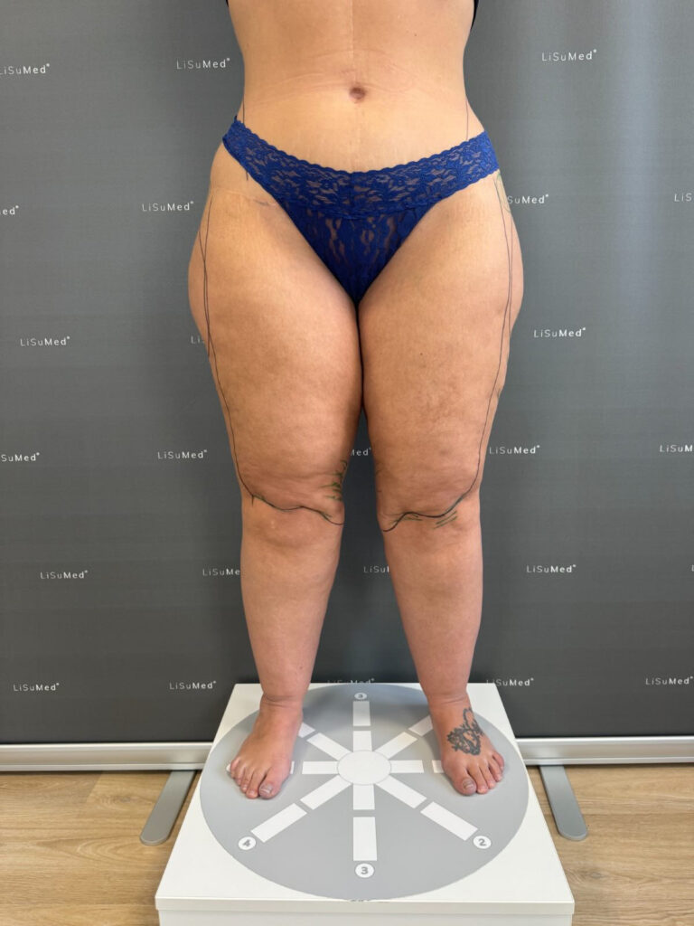 Stage 3 Lipedema Characteristics