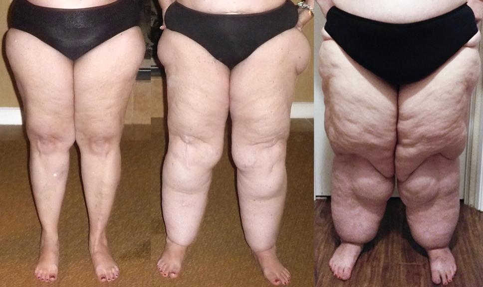 Lipedema Characteristics