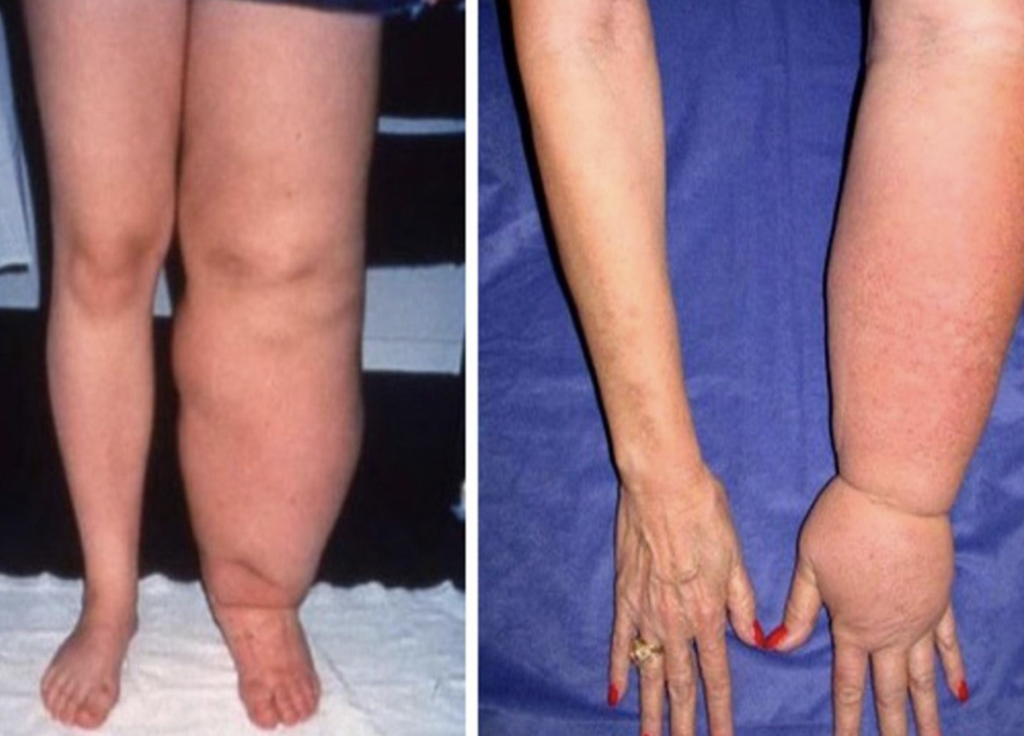 Lymphedema Characteristics
