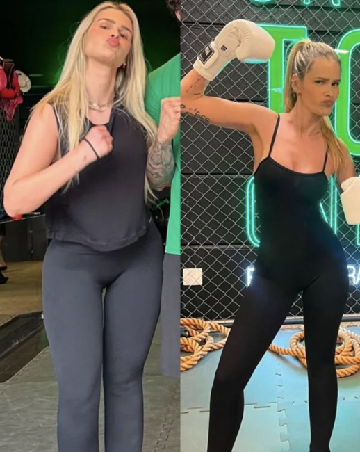 Yasmin Brunet - Lipedema