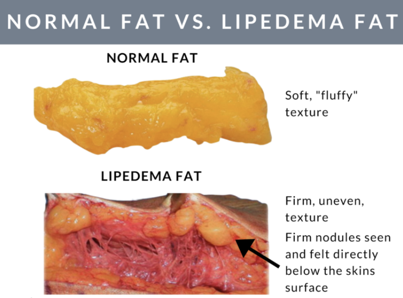 Lipedema Fat vs Normal Fat