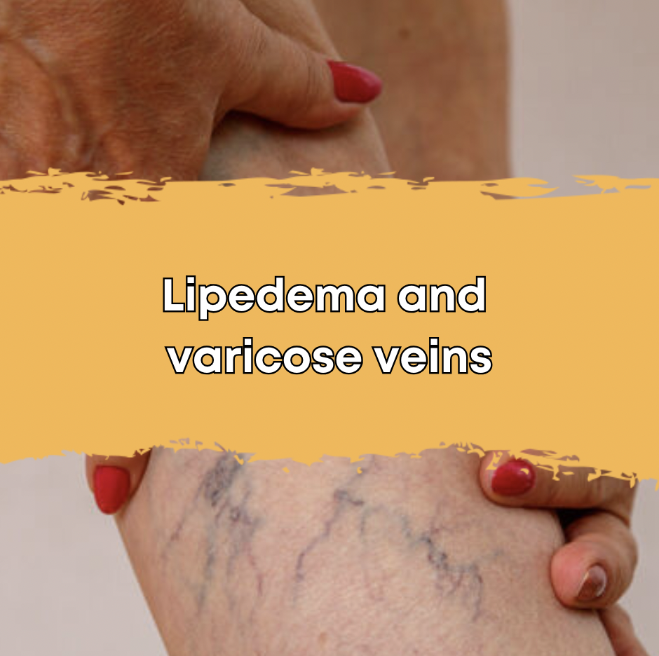 Lipedema and varicose veins