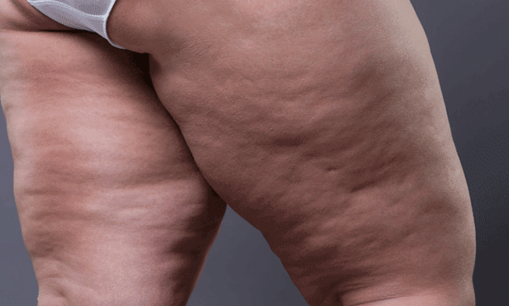 What is Cellulite?