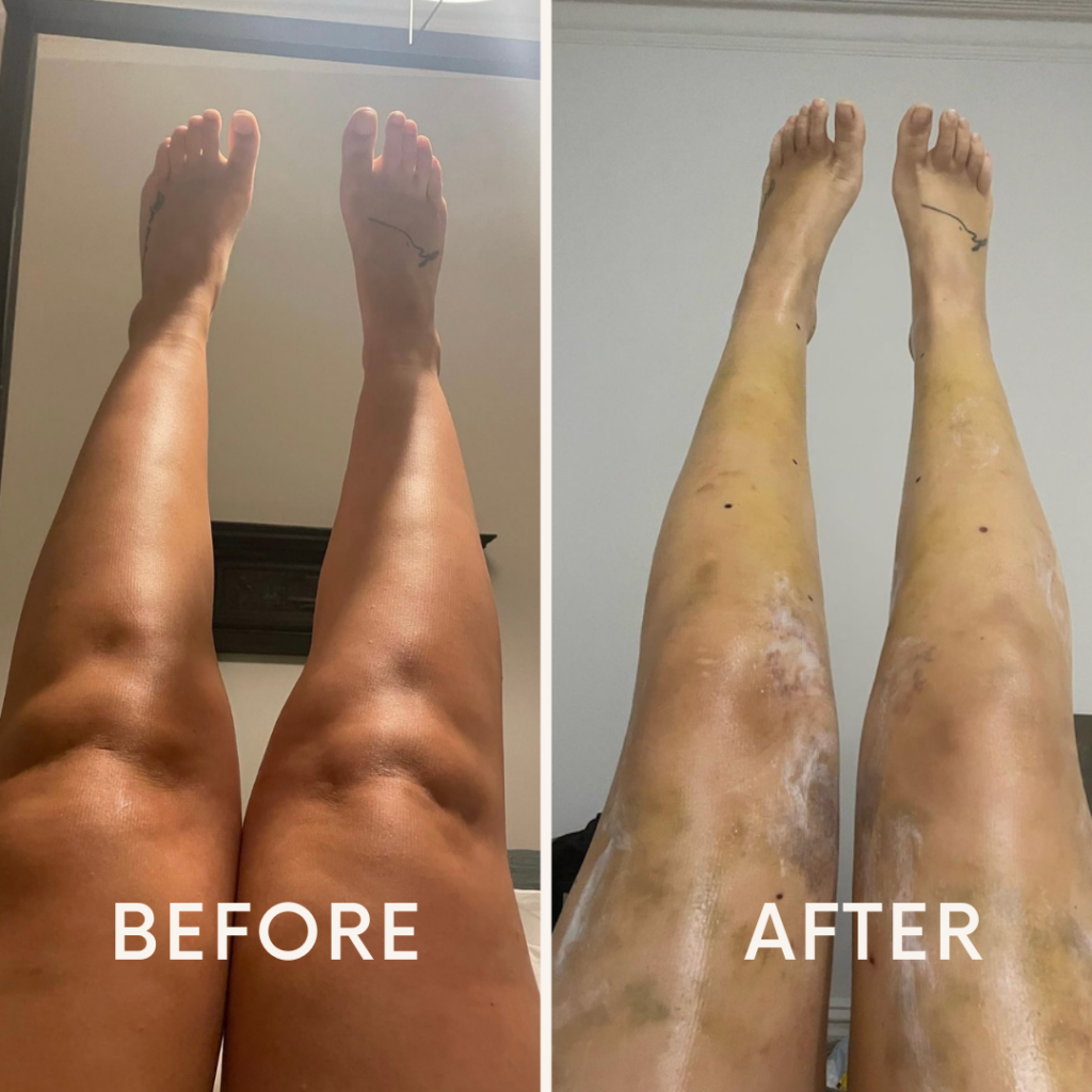 Before and After Lipedema Stage 2 Knees & Lower Legs