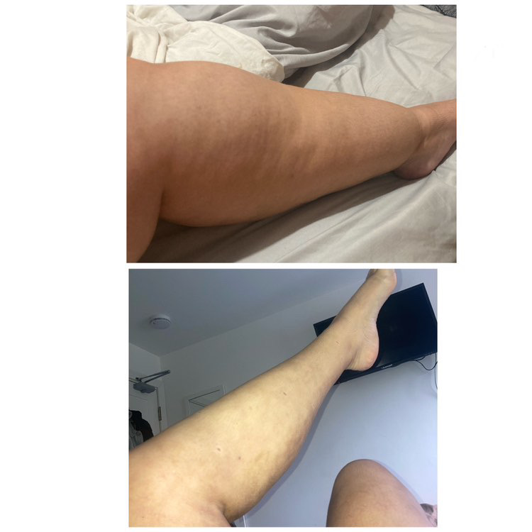 Before and After WAL Liposuction