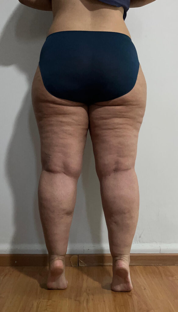 Lipedema Stage 2 Back