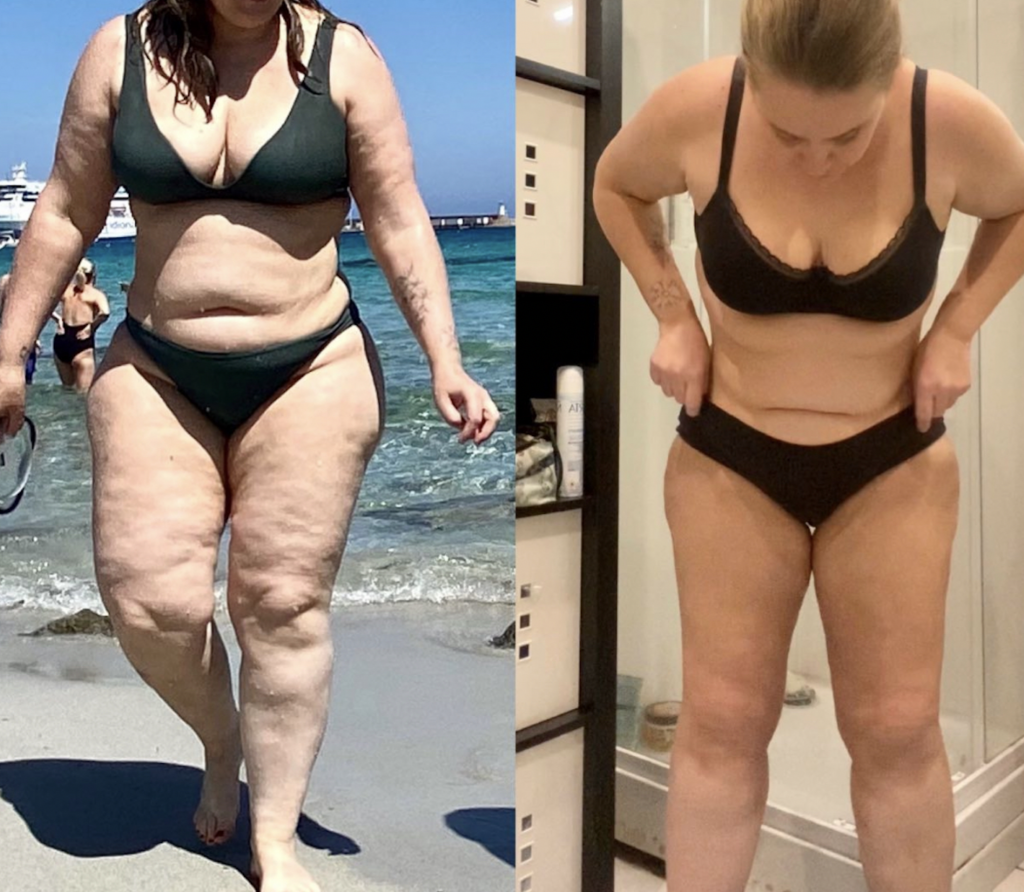 Lipedema Stage 3 Before and After - One Surgery