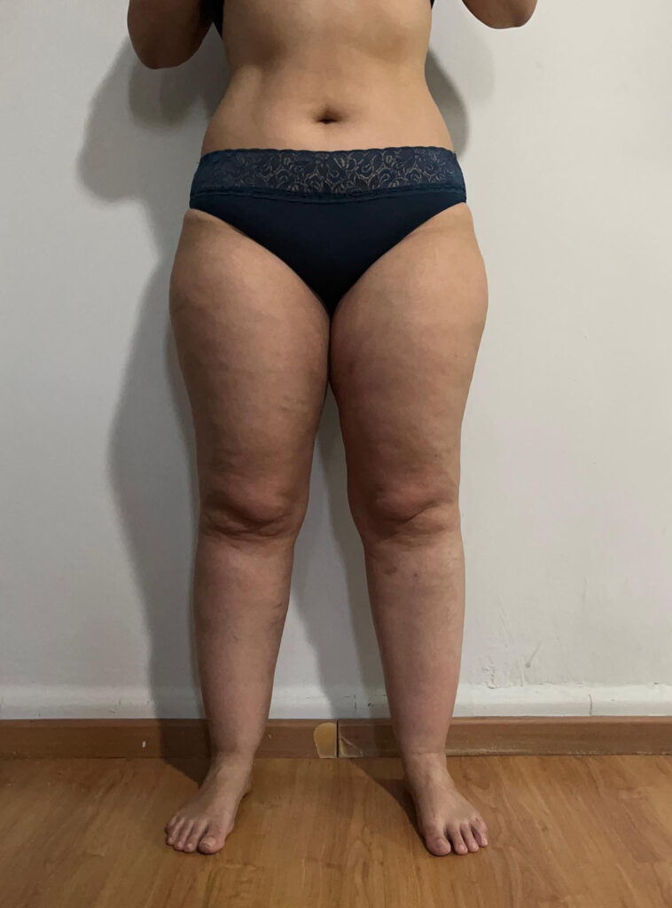 Lipedema Stage 2 Full Legs Front View