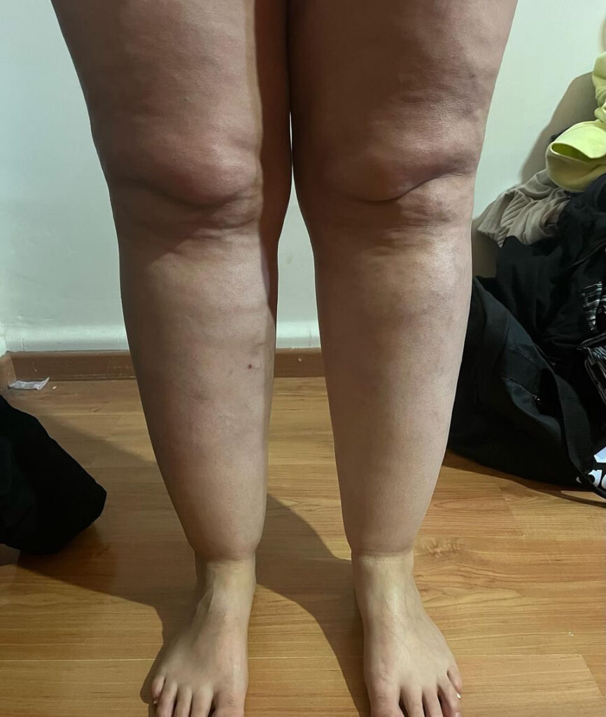 Lipedema Stage 2 Knees