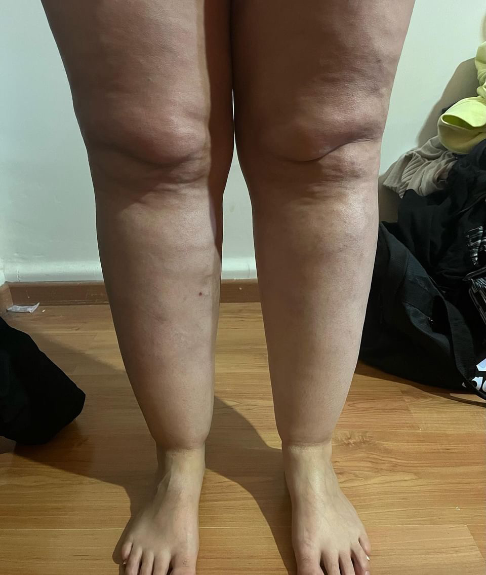 Lipedema Stage 2 Knees