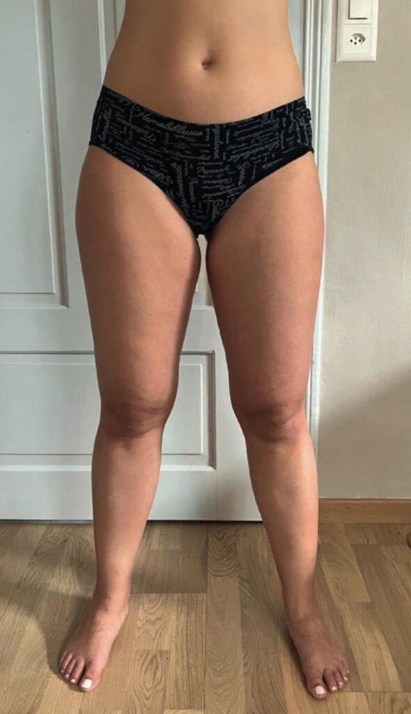 Stage 1 Lipedema Full Legs