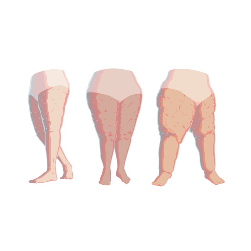 Can you prevent Lipedema?