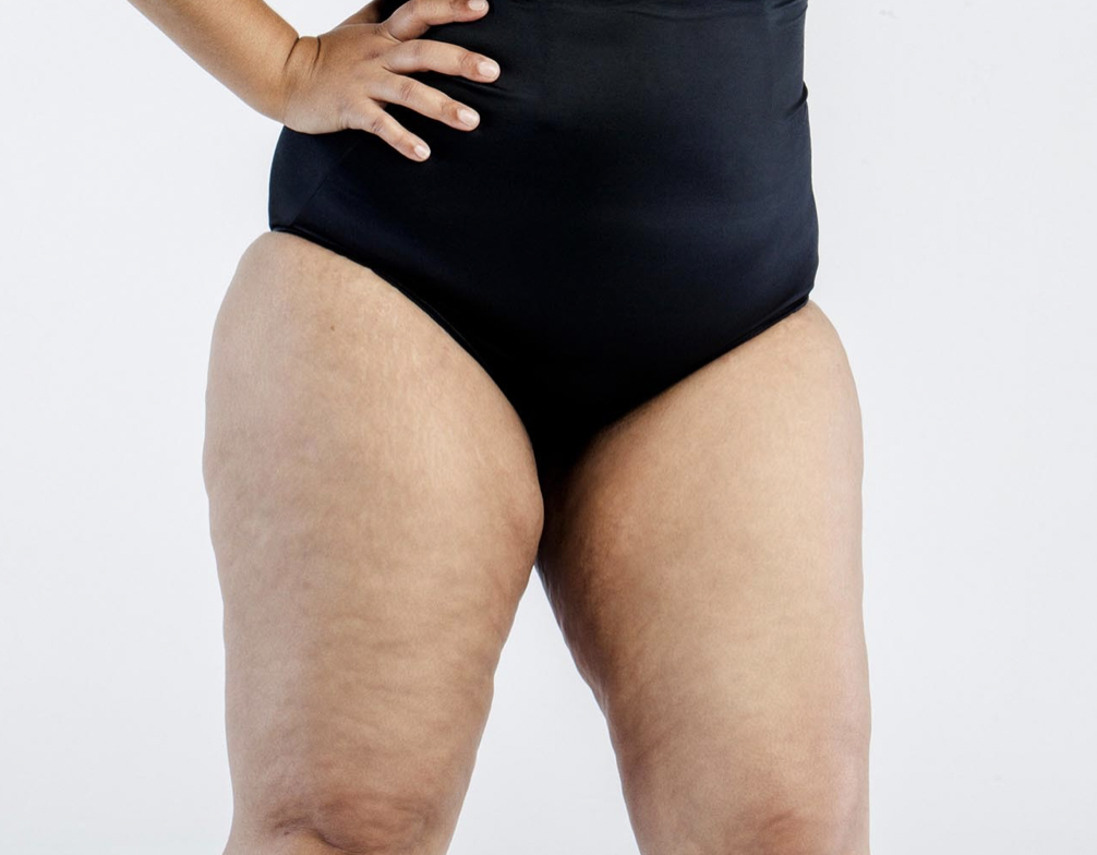 Lipedema Texture
