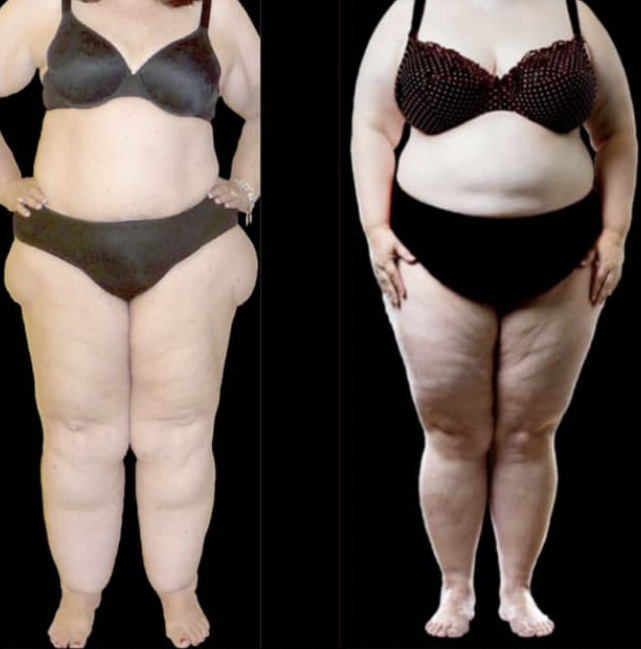 Lipedema vs Obesity