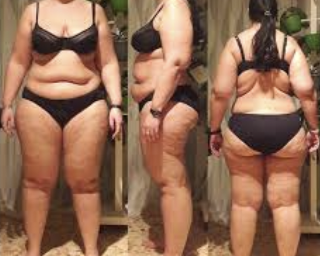 Lipedema and keto diet before