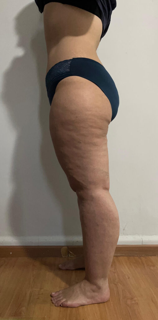 Lipedema Stage 2 Side View