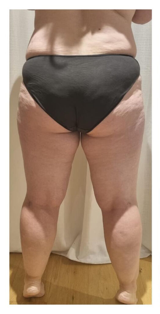 Lipedema Stage 3 Back View