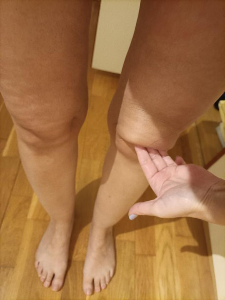 Stage 1 Lipedema Knees