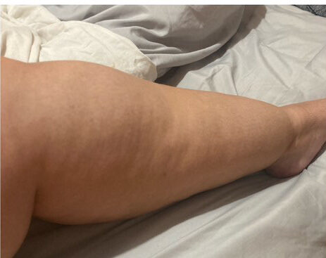 Stage 3 Lipedema Calf