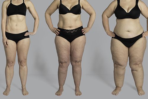 Does Lipedema get worse?