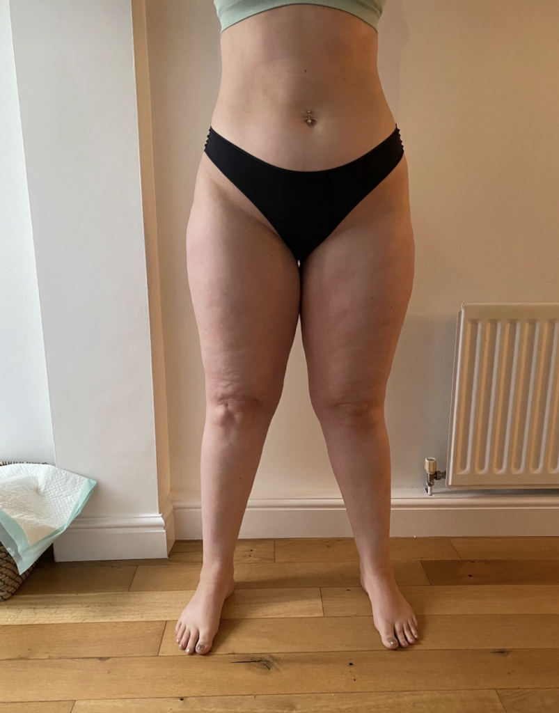Stage 2 Lipedema Legs