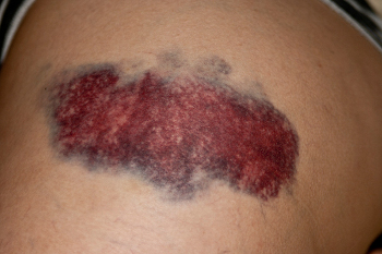 Lipedema Bruising