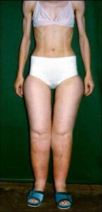 Lipedema and Anorexia