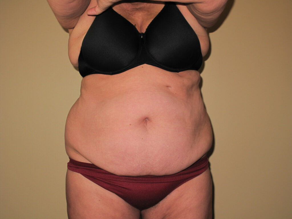 Lipedema in the abdomen