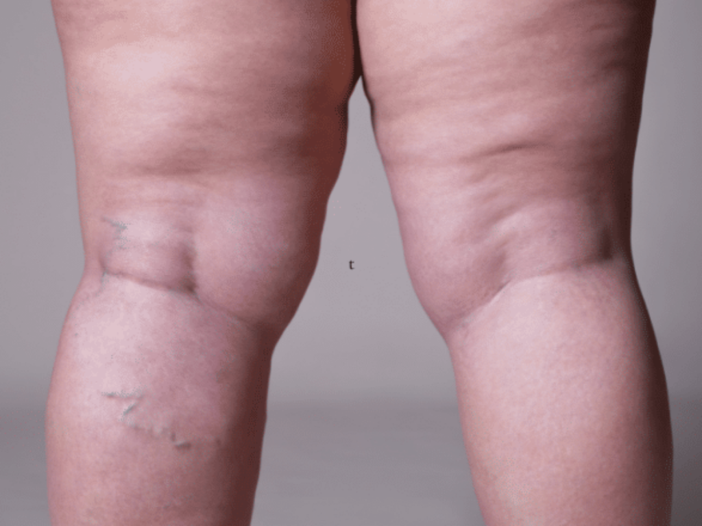 Lipedema legs
