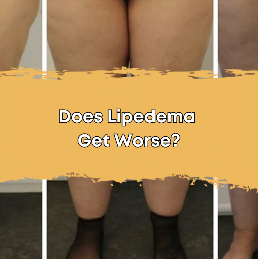 Does Lipedema Get Worse?