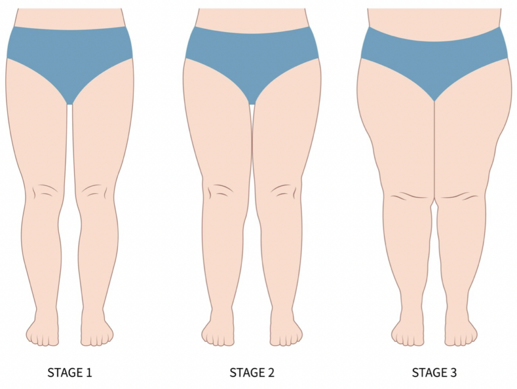 Stages of Lipedema