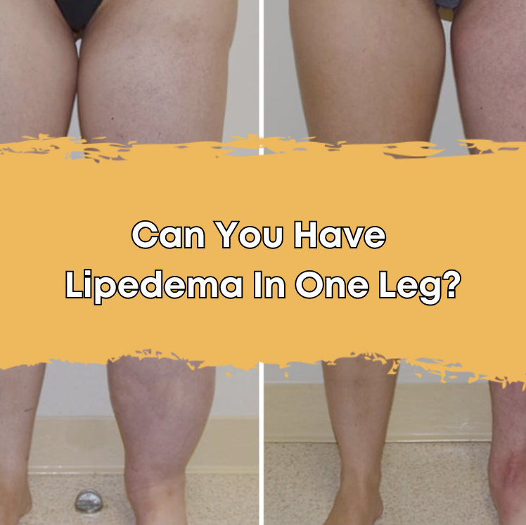 Can You Have Lipedema In One Leg?