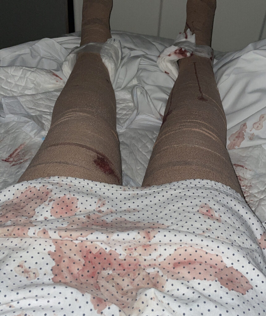 Lipedema Reduction Surgery - Before and After