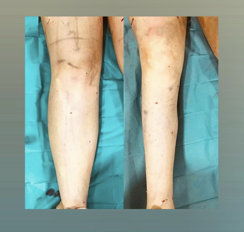 Immediately before and after Lipedema surgery
