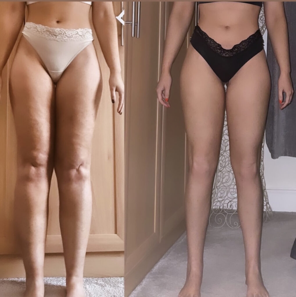 9 months post Lipedema Reduction Surgery