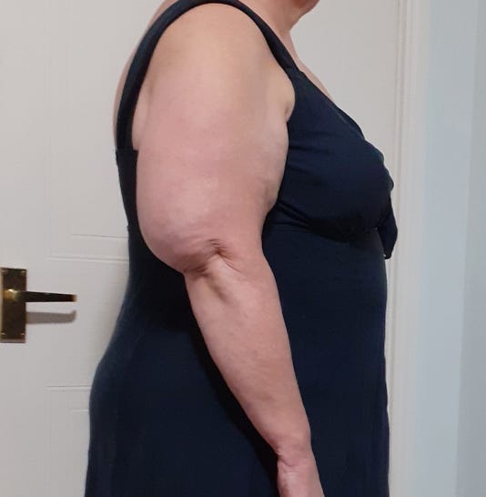 Lipedema Upper Arms Elbow Cuff