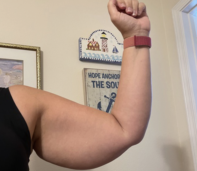 Lipedema Upper Arms