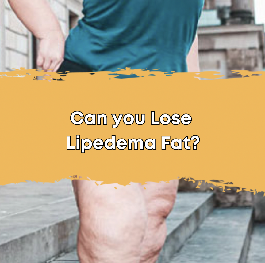 Can you Lose Lipedema Fat?