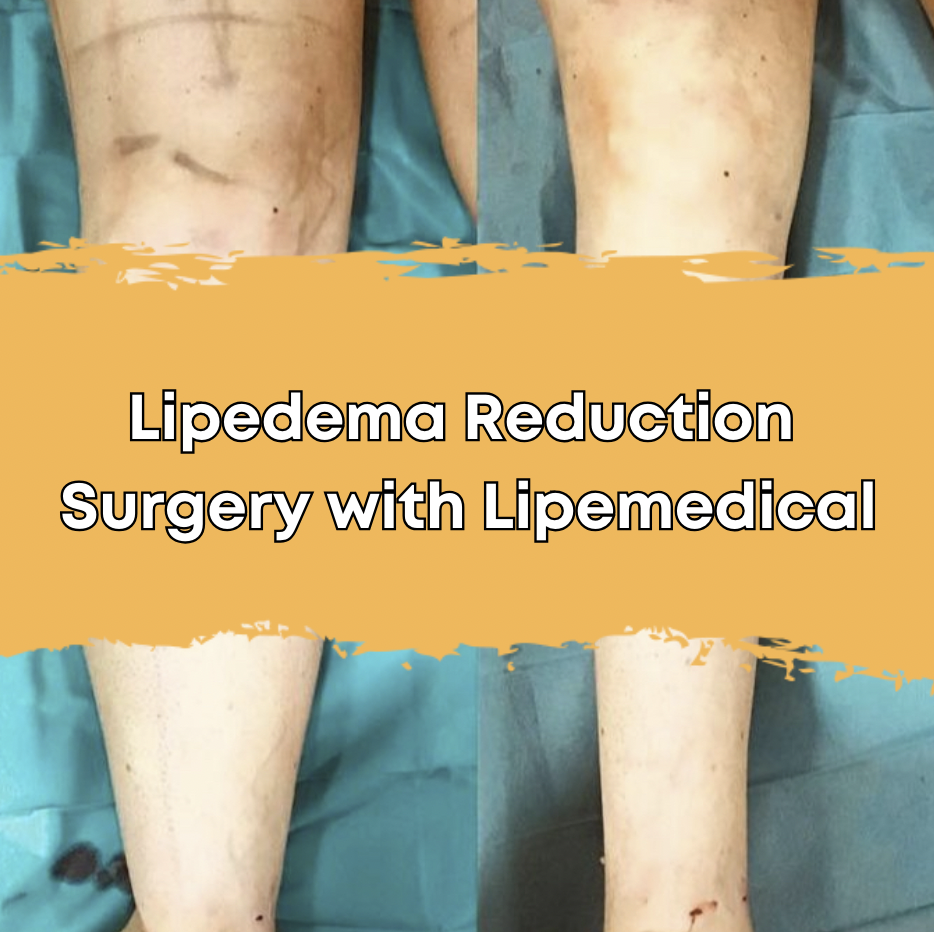 Lipedema Reduction Surgery with Lipemedical