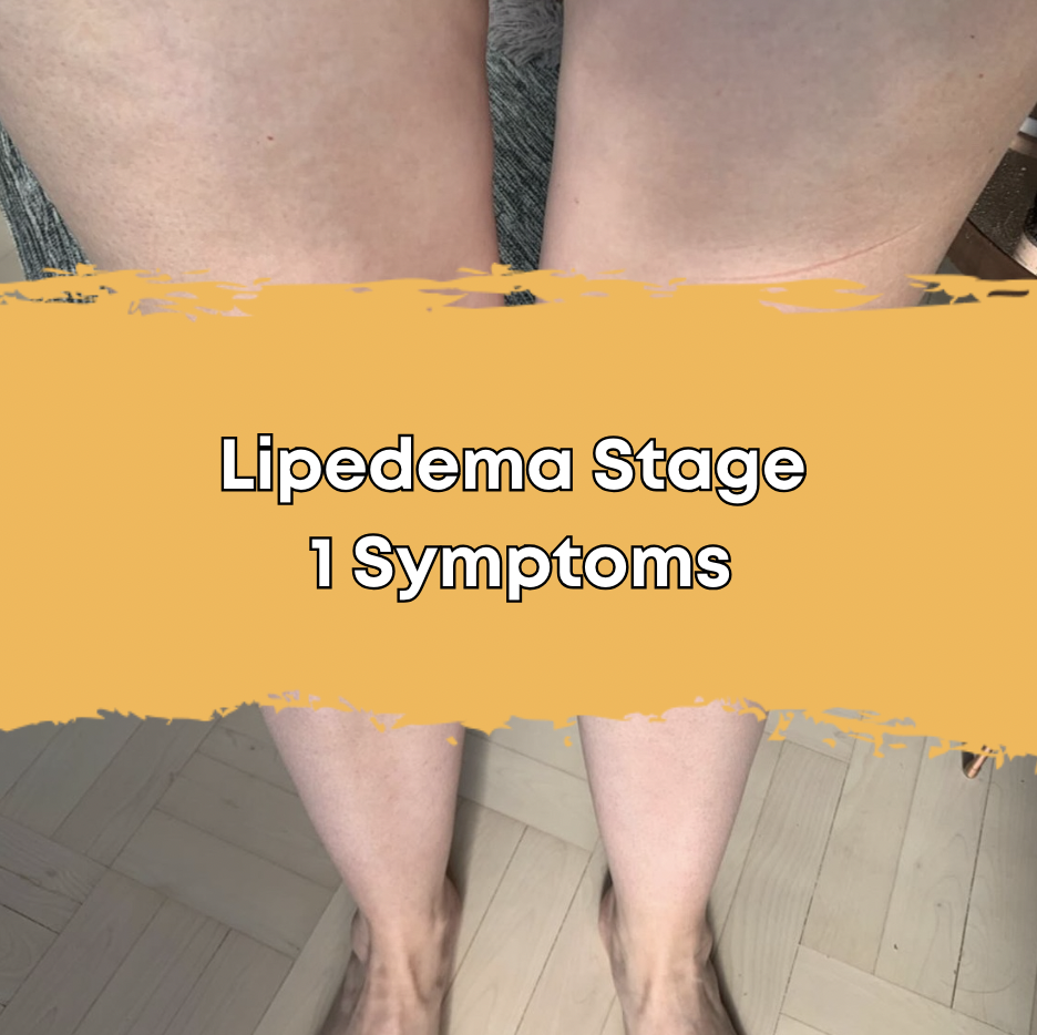 Lipedema Stage 1 Symptoms