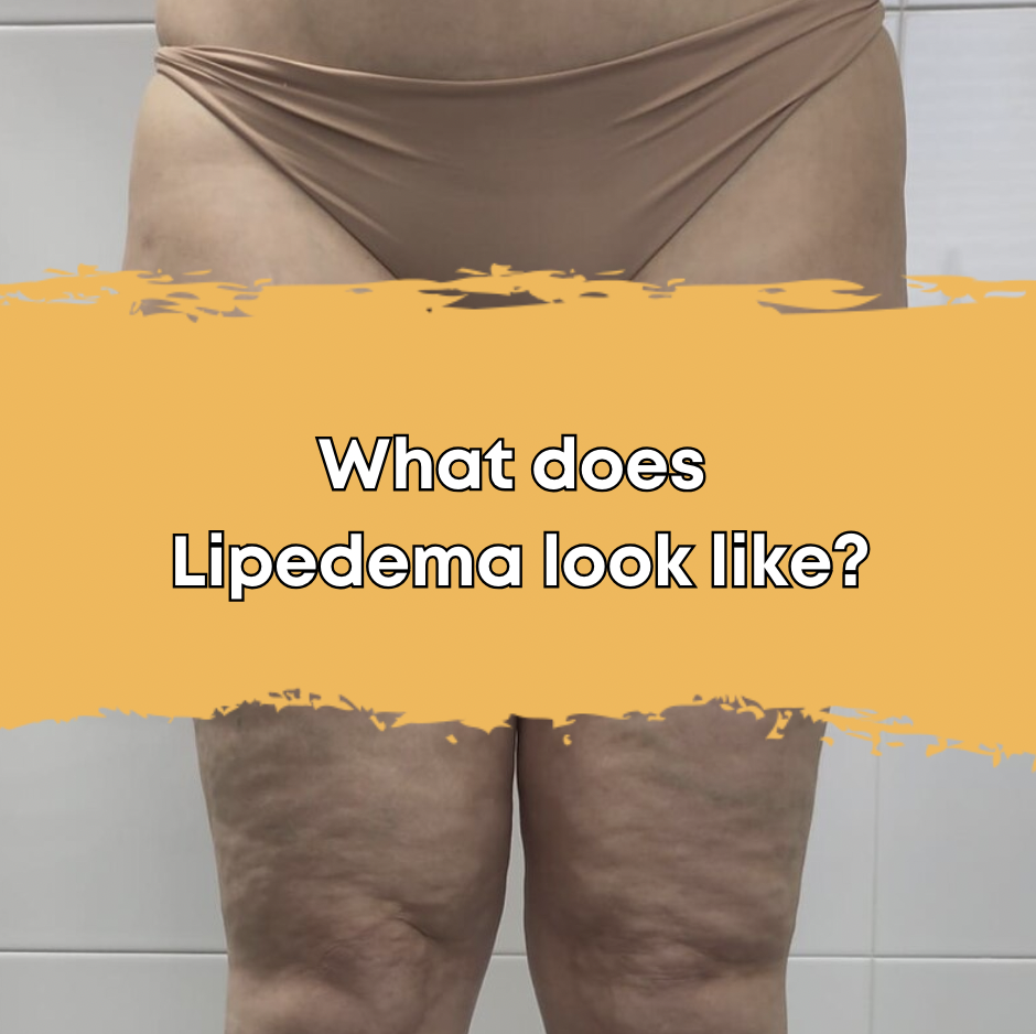 What does Lipedema look like?