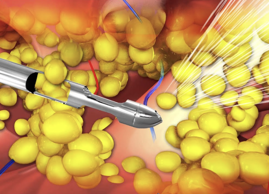 Liposuction for Lipedema