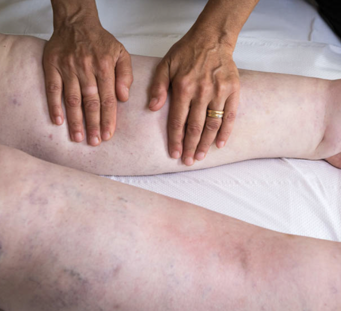 MLD for Lipedema