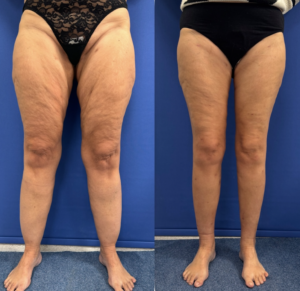 Thigh Lift for Lipedema