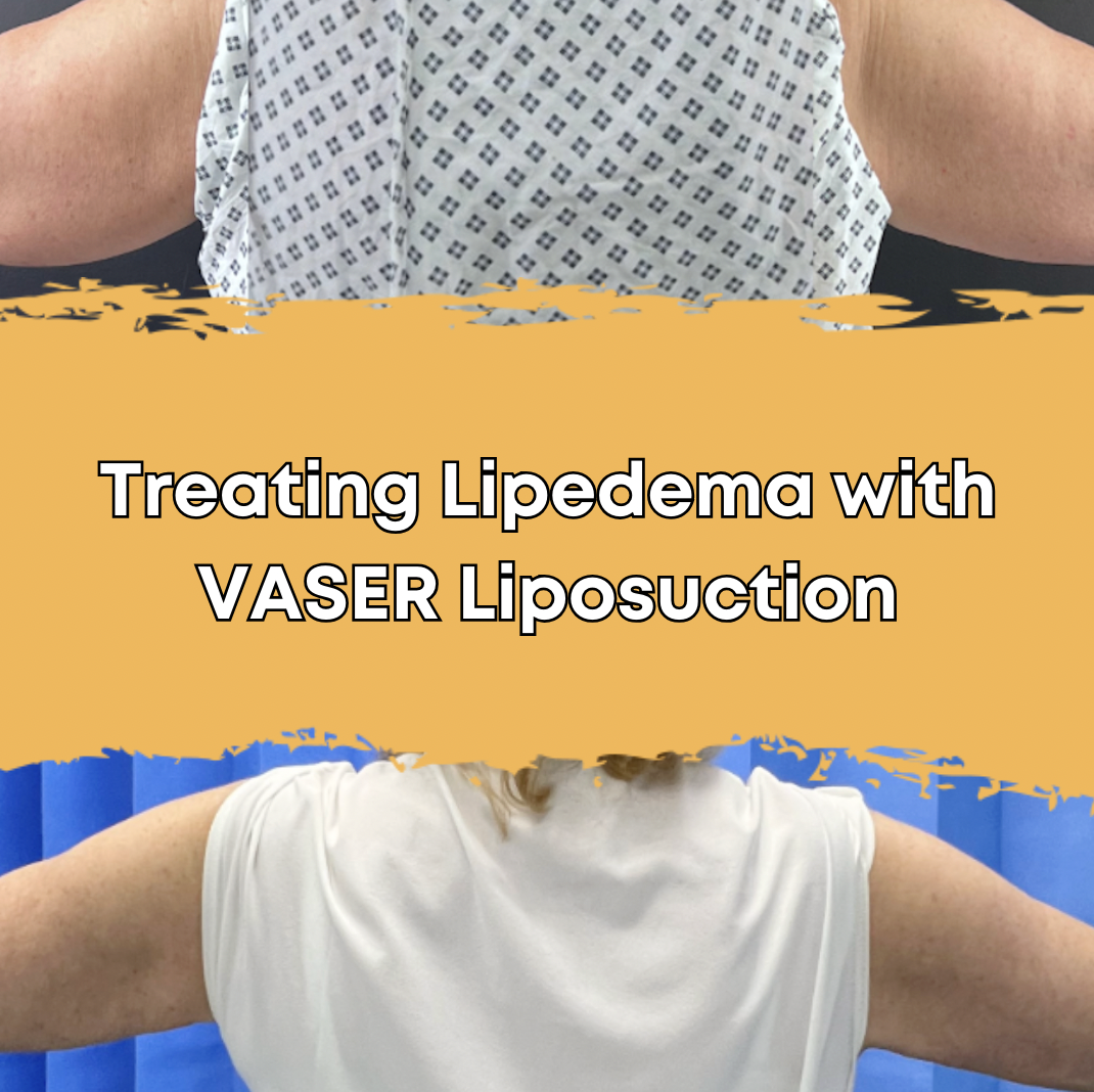 Treating Lipedema with VASER Liposuction