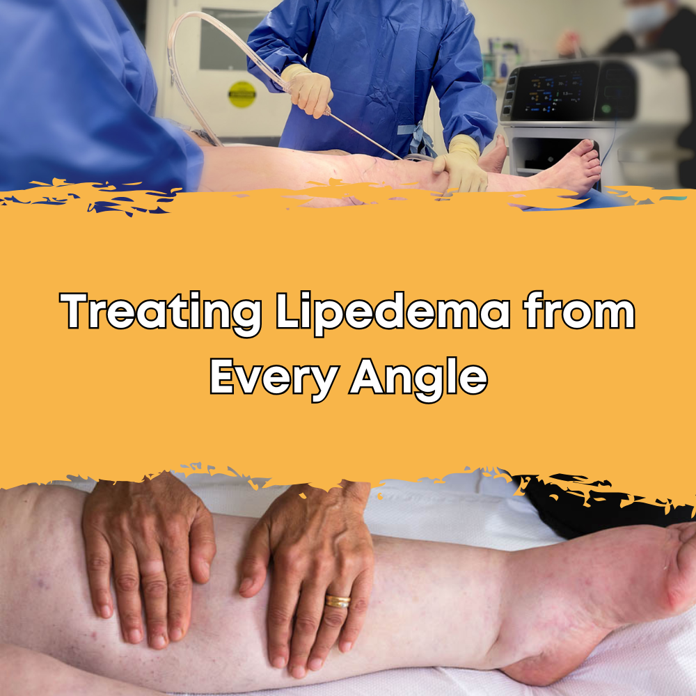 Treating Lipedema from Every Angle